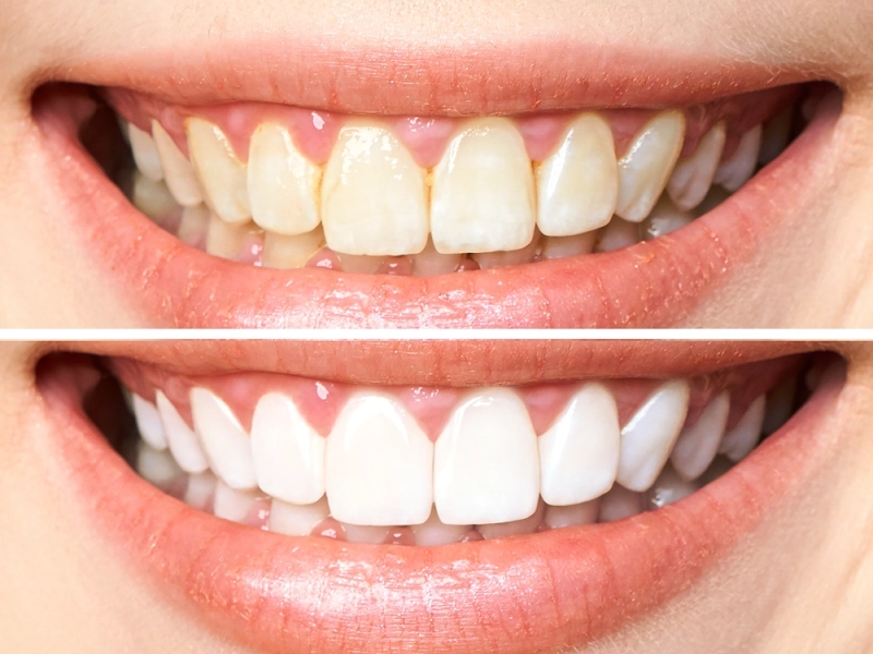 Blanqueamiento dental