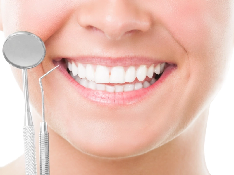 Carillas de composite