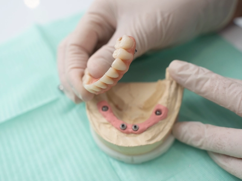 Prótesis sobre implantes