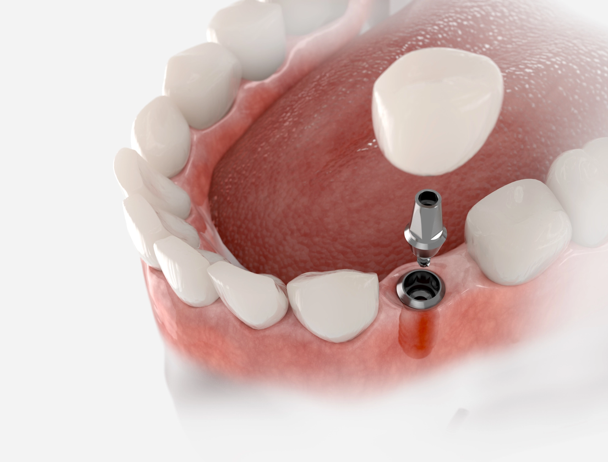 ¿Cuándo podemos colocar implantes de carga inmediata en Valencia?