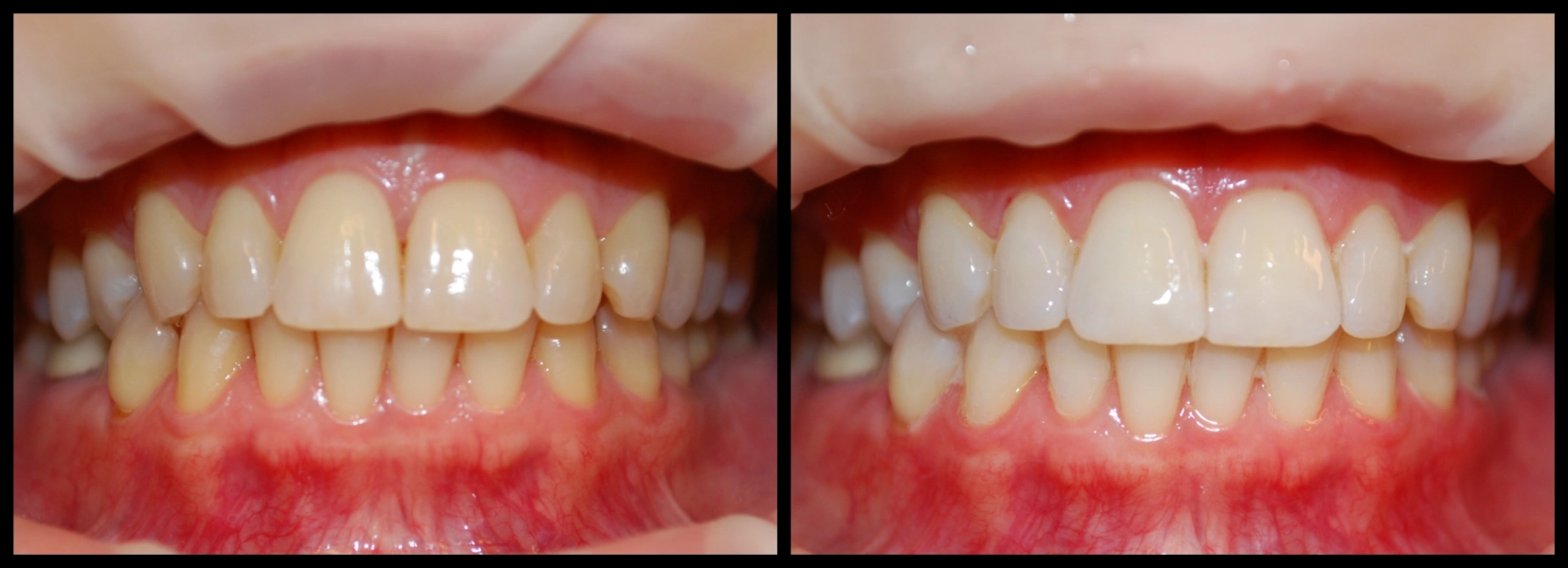 Por qué en algunos dientes no funciona el blanqueamiento.